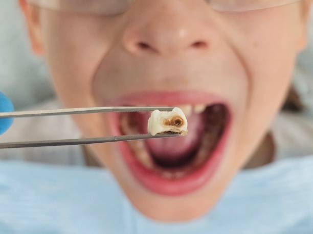 Best Emergency Root Canal Treatment in Oak Ridge North, TX
